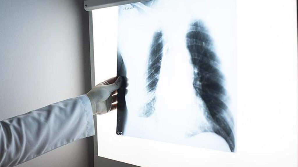 DSÖ açıkladı: 2024 yılında 1,2 milyon kişi tüberkülozdan öldü